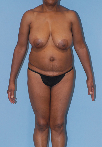 Breast Reduction And Lift Before & After Image