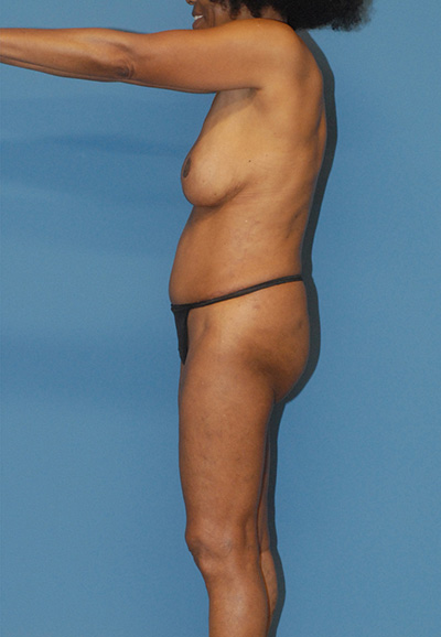 Breast Reduction And Lift Before & After Image