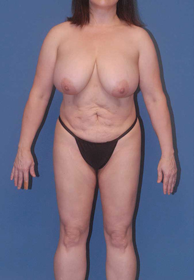 Breast Reduction And Lift Before & After Image