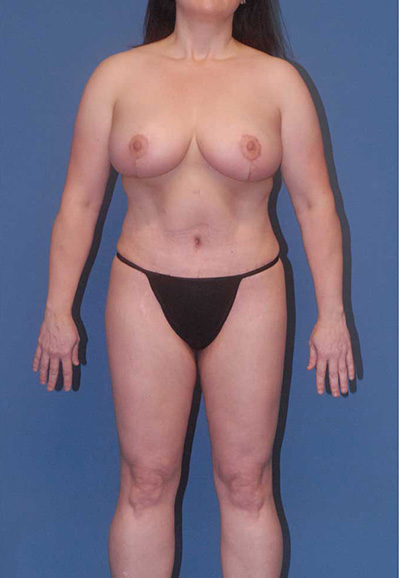 Breast Reduction And Lift Before & After Image