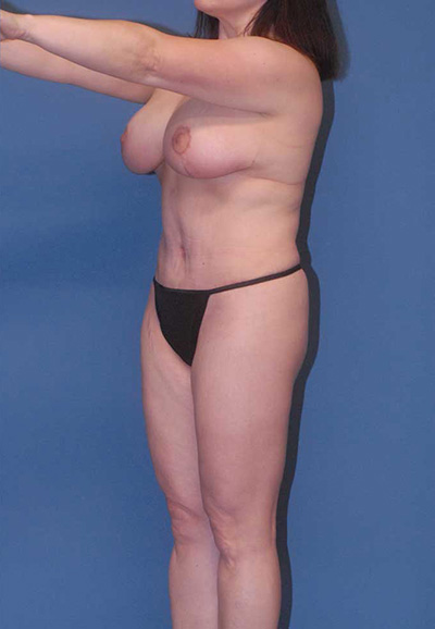 Breast Reduction And Lift Before & After Image