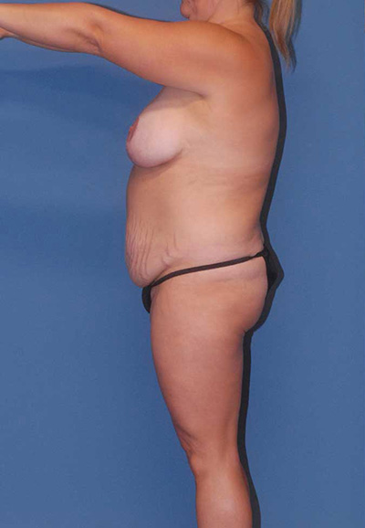 Breast Reduction And Lift Before & After Image