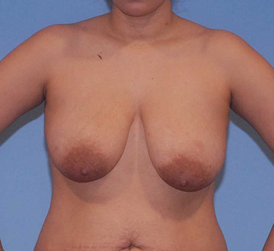 Breast Reduction And Lift Before & After Image