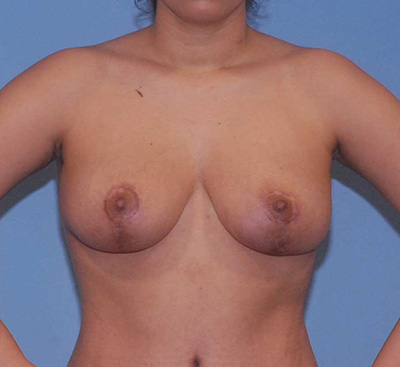 Breast Reduction And Lift Before & After Image
