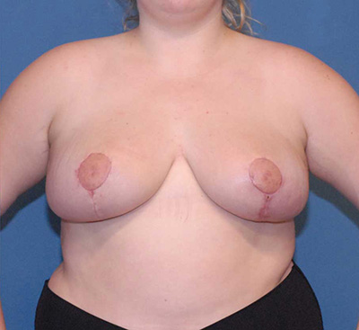 Breast Reduction And Lift Before & After Image