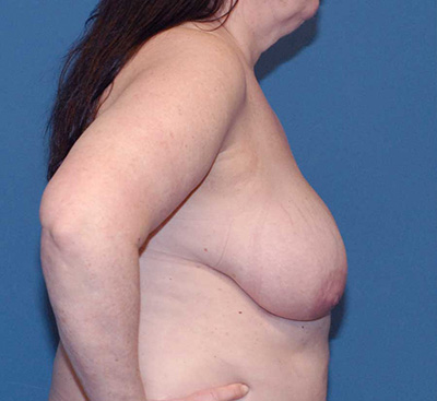 Breast Reduction And Lift Before & After Image