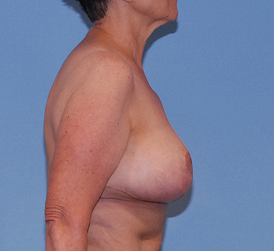 Breast Reduction And Lift Before & After Image