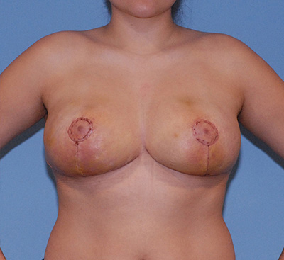 Breast Reduction And Lift Before & After Image