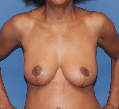 Breast Reduction And Lift Before & After Image
