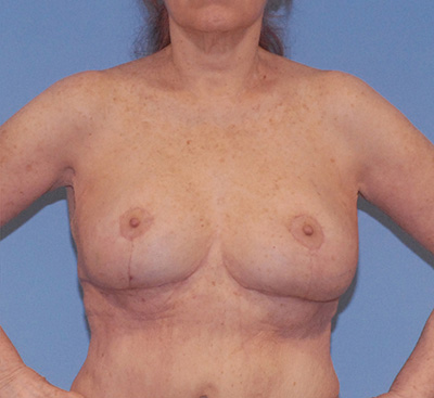 Breast Reduction And Lift Before & After Image