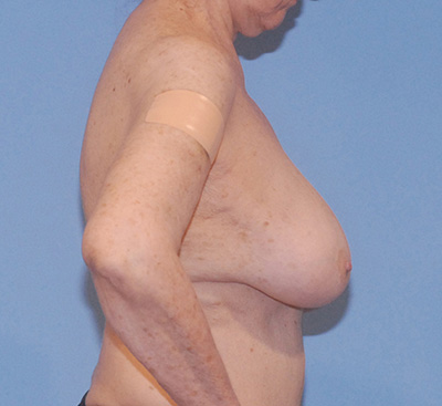 Breast Reduction And Lift Before & After Image