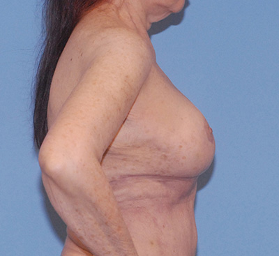 Breast Reduction And Lift Before & After Image