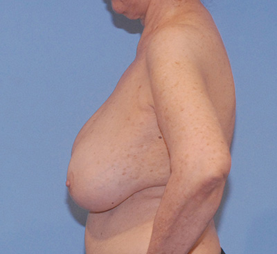 Breast Reduction And Lift Before & After Image