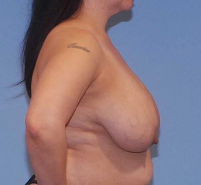 Breast Reduction And Lift Before & After Image