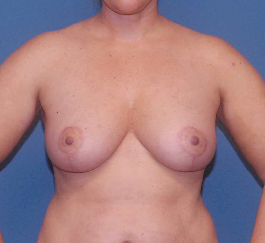 Fat Grafting to Breast Before & After Image