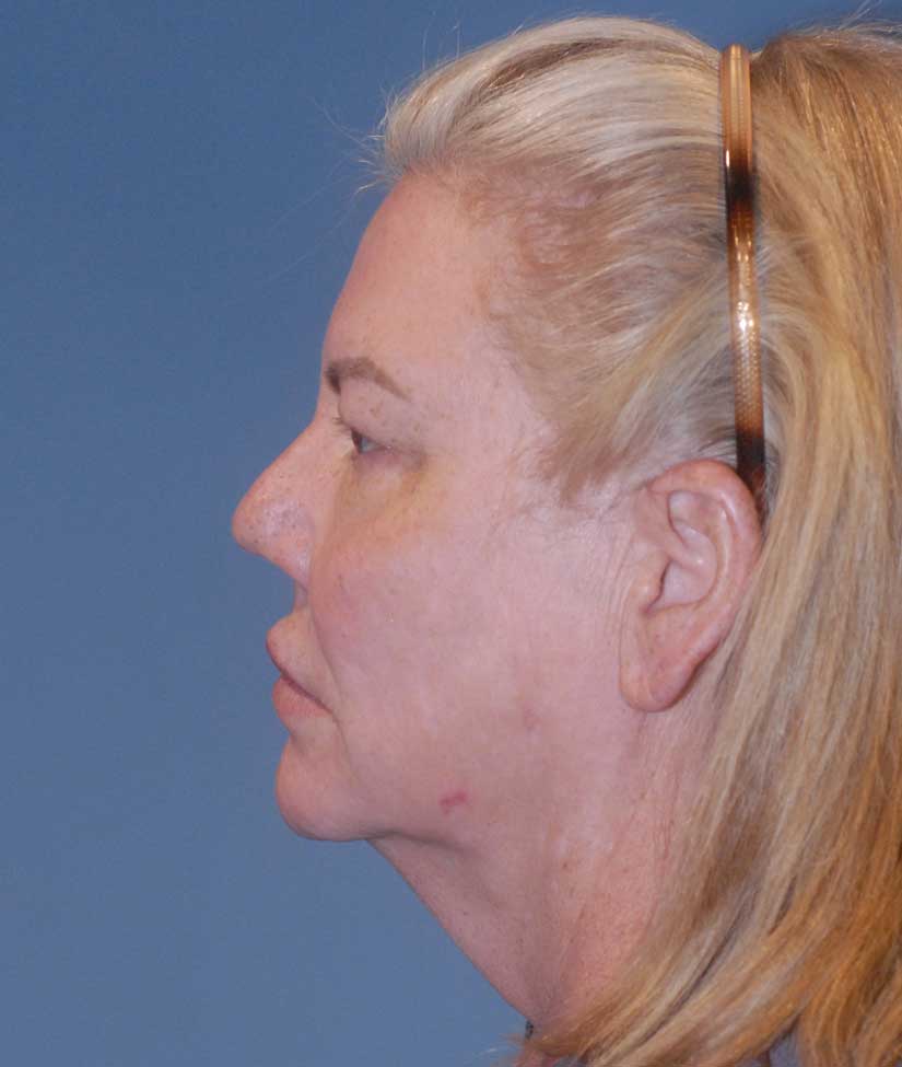 Blepharoplasty Before & After Image