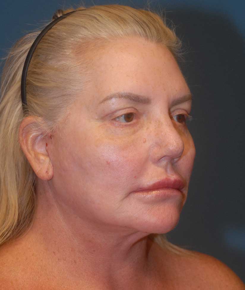 Face Fat Grafting Before & After Image