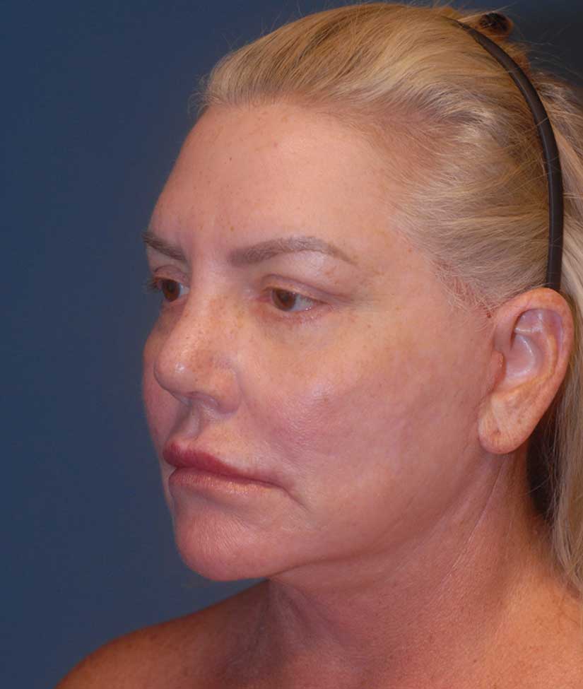 Face Fat Grafting Before & After Image