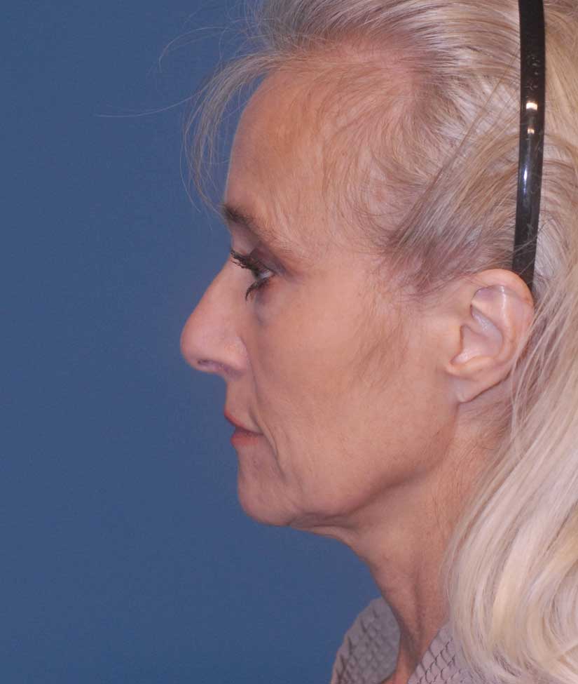 Female Facial Rejuvenation Before & After Image