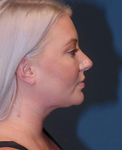 Facial Liposuction Before & After Image