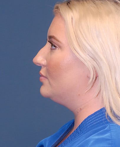 Facial Liposuction Before & After Image