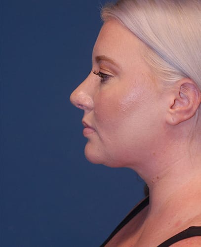 Facial Liposuction Before & After Image