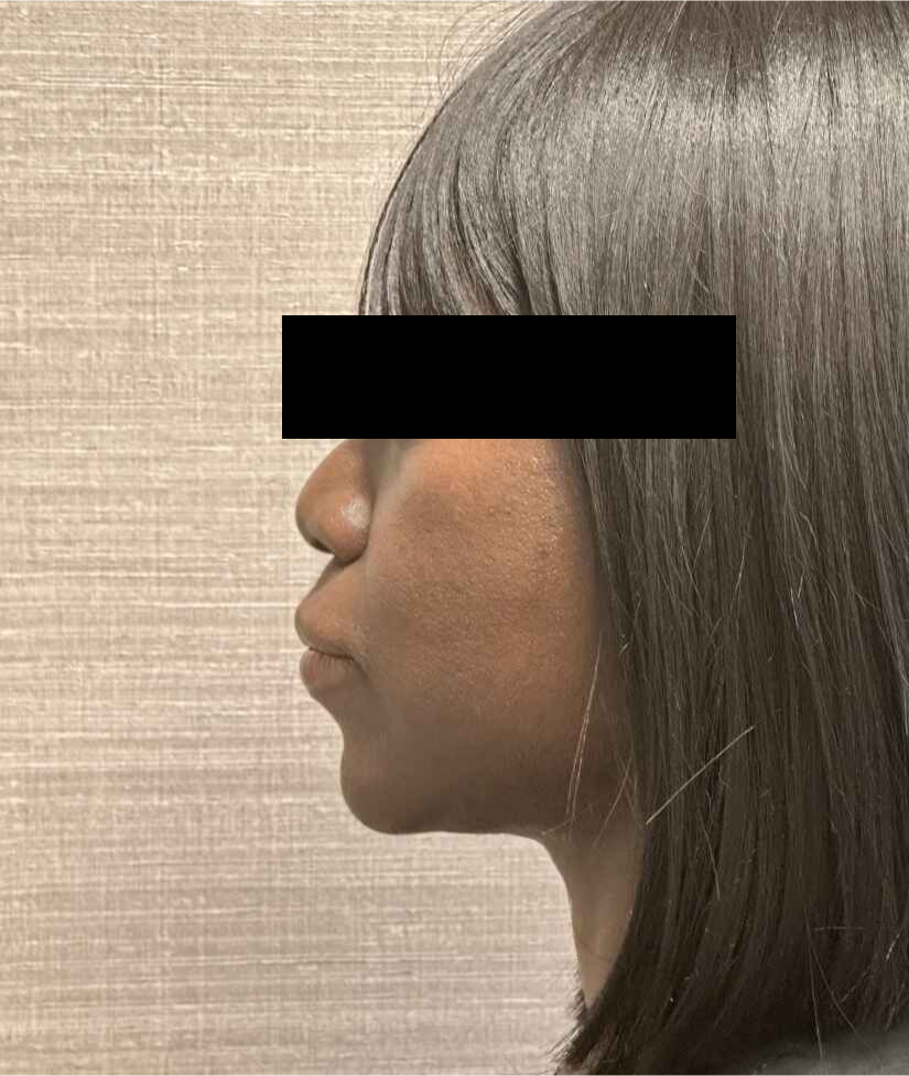 Facial Liposuction Before & After Image