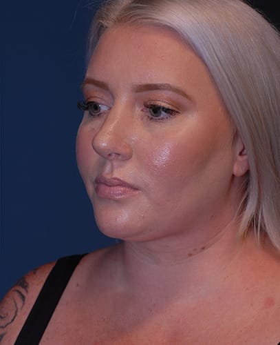 Rhinoplasty Before & After Image