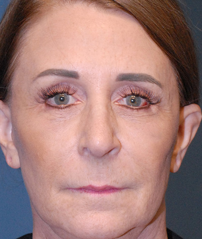 Rhinoplasty Before & After Image