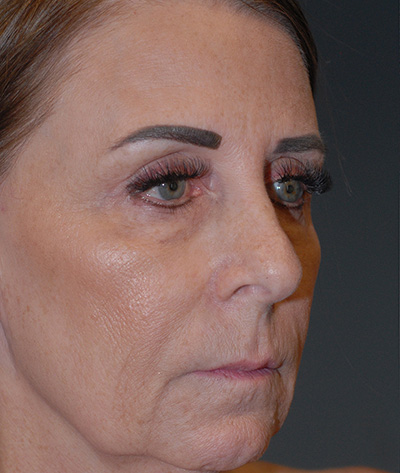 Rhinoplasty Before & After Image