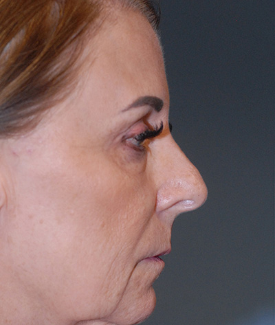 Rhinoplasty Before & After Image