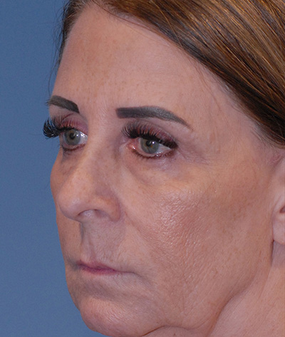 Rhinoplasty Before & After Image