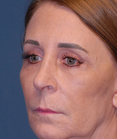 Rhinoplasty Before & After Image
