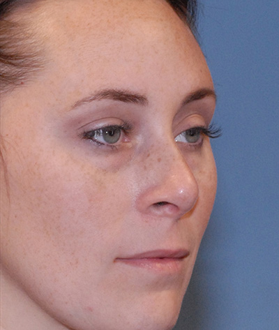 Rhinoplasty Before & After Image