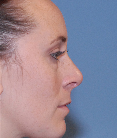 Rhinoplasty Before & After Image