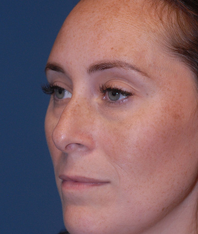 Rhinoplasty Before & After Image