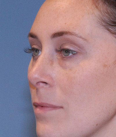Rhinoplasty Before & After Image