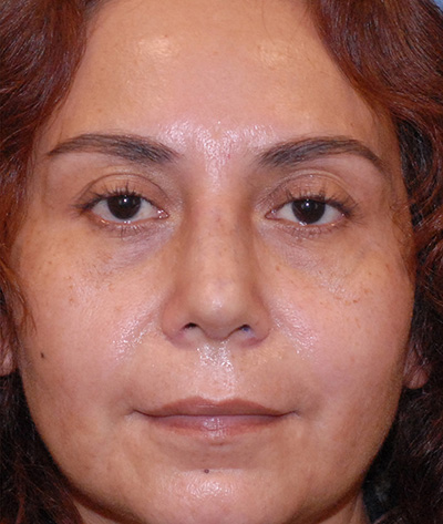 Rhinoplasty Before & After Image