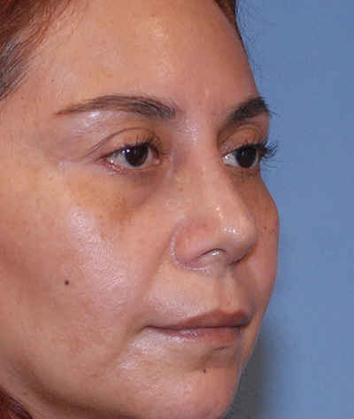 Rhinoplasty Before & After Image
