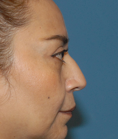 Rhinoplasty Before & After Image