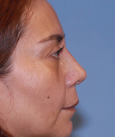Rhinoplasty Before & After Image