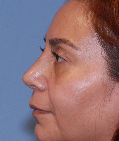 Rhinoplasty Before & After Image