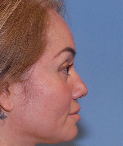 Rhinoplasty Before & After Image