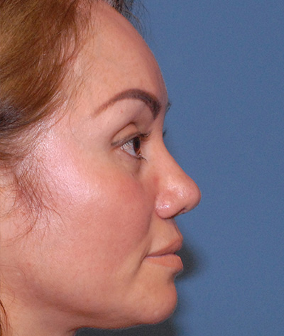 Rhinoplasty Before & After Image