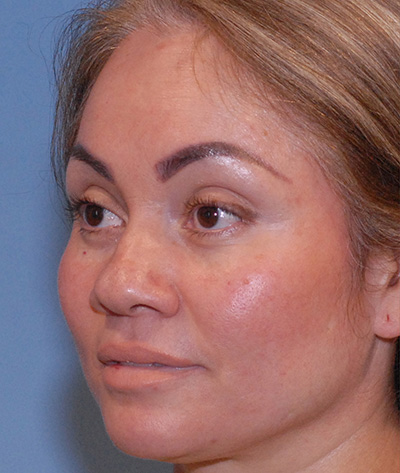 Rhinoplasty Before & After Image