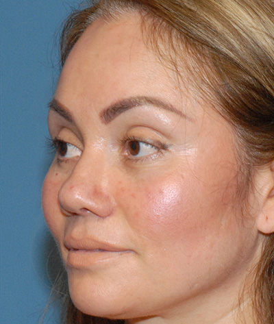 Rhinoplasty Before & After Image
