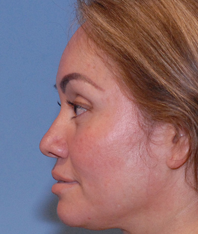 Rhinoplasty Before & After Image