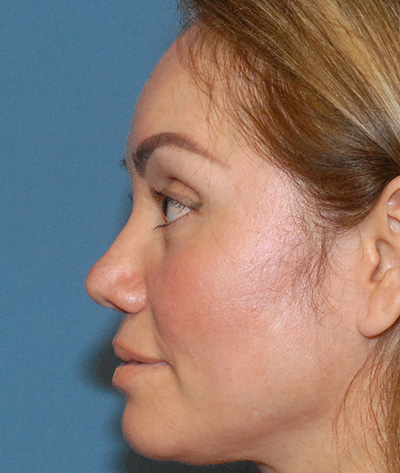 Rhinoplasty Before & After Image