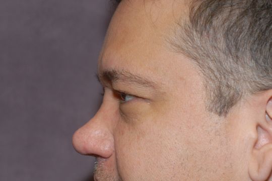 Blepharoplasty Before & After Image