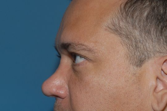 Blepharoplasty Before & After Image